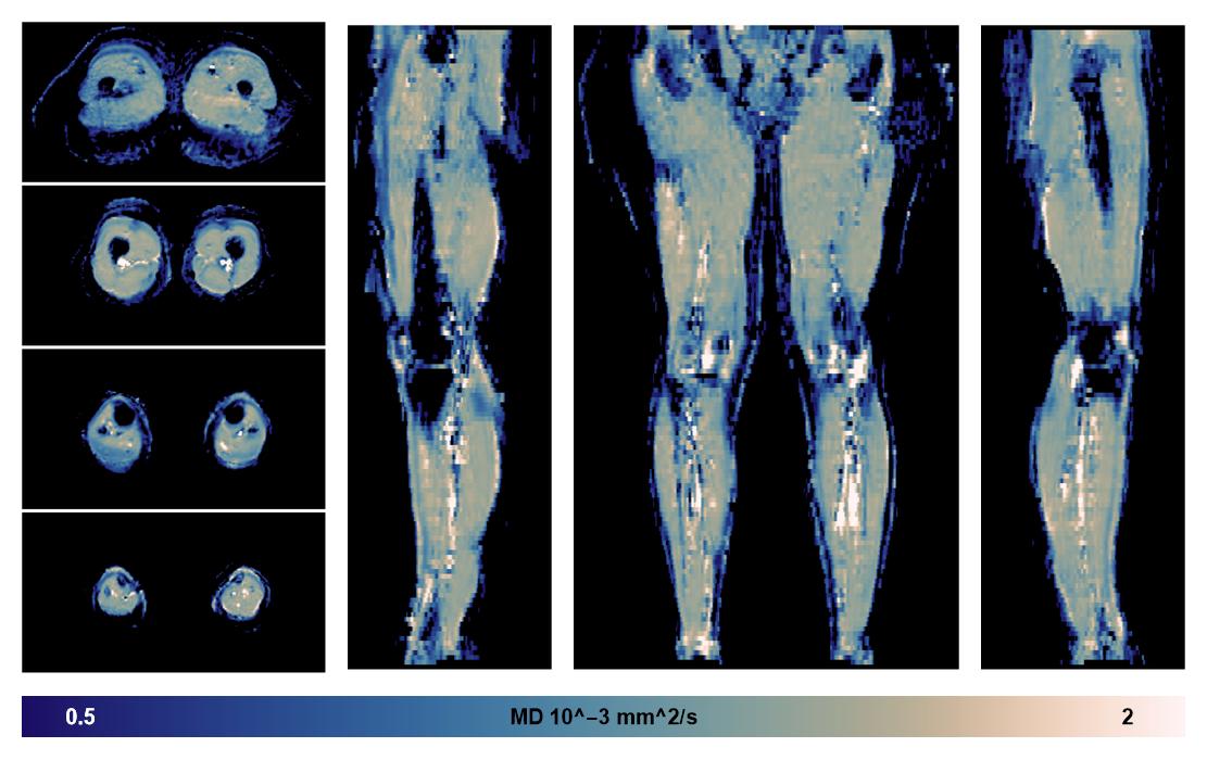 IVIM corrected whole leg muscle mean diffusivity obtained from diffusion tensor imaging.